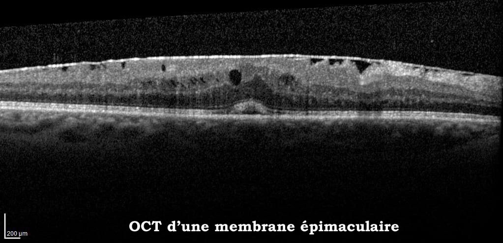 Scanner d'une membrane épimaculaire