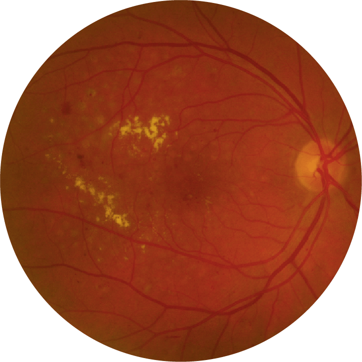Photo d'un fond d'oeil atteint d'une rétinopathie diabétique sévère