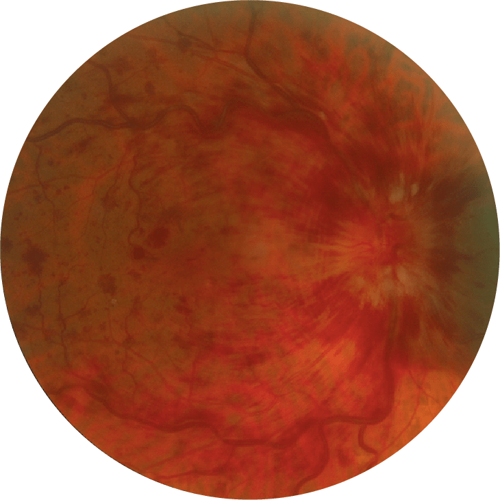 Photo d'un fond d'œil atteint d'une occlusion de la veine centrale de la rétine