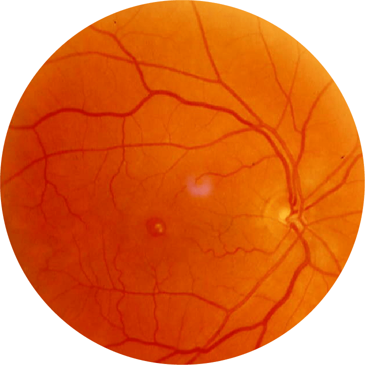 Rétinographie du fond d'œil avec un trou maculaire au centre de la rétine